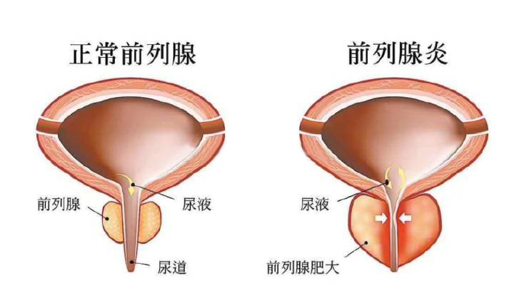 前列腺炎最新研究突破，開啟未來治療新篇章